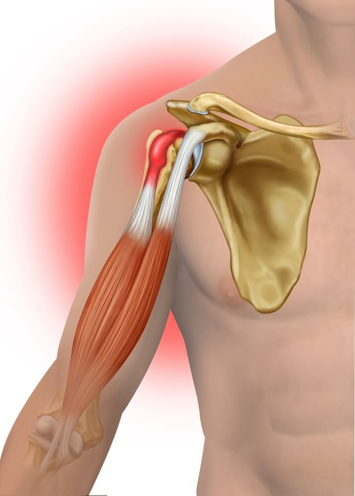 Tendinitis and How Chiropractic Care Can Help