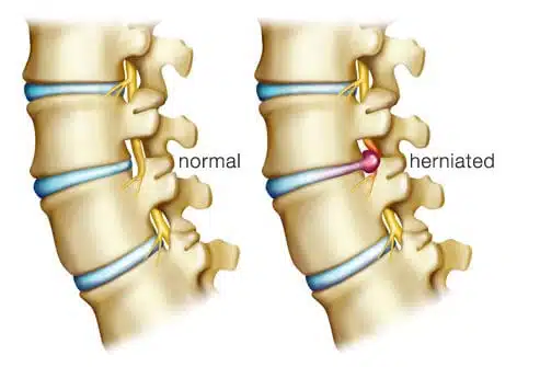 Disc Herniation and Chiropractic Care